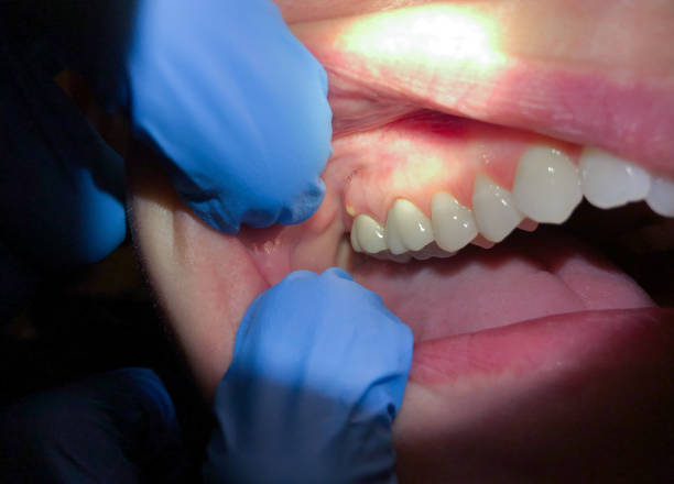 Best Teeth Whitening  in Lumberton, MS